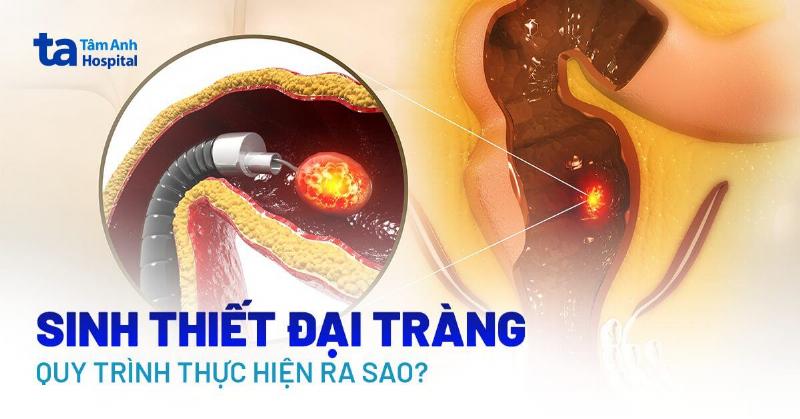 Hình ảnh mẫu sinh thiết polyp đại tràng dưới kính hiển vi